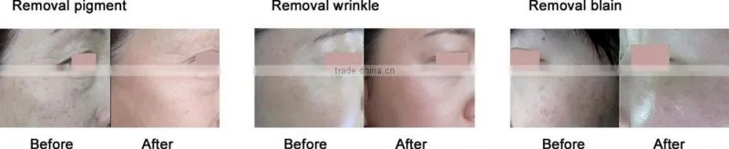 Fractional CO2 Laser beauty for superfacial Acne scar surgery equipment with medical CE and ISO approved
