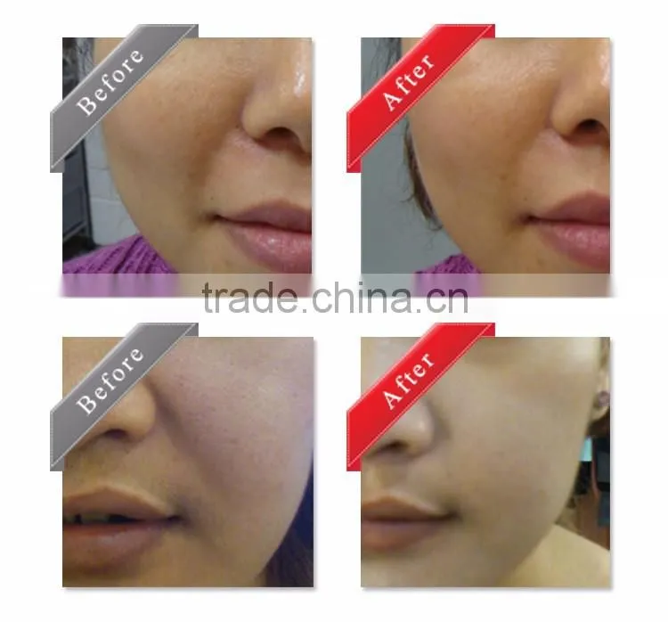 Beauty Face Mask face lift up hydrating Facial Mask gel
