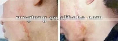 skin renewing co2 laser scar treatment co2 fractional laser co2 surgical laser instrument