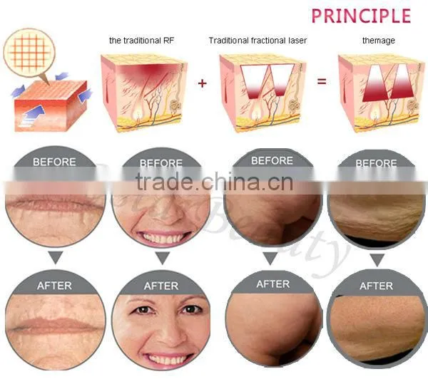 Fractional rf microneedle