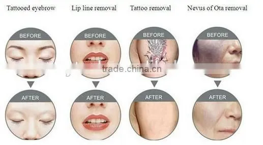 CE approval long pulse nd yag laser tattoo removal pigmentation removal VH620