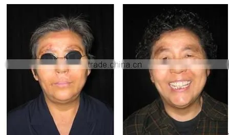 Shipping free 311 nm nb uvb lamp for vitiligo treatment at home!!!