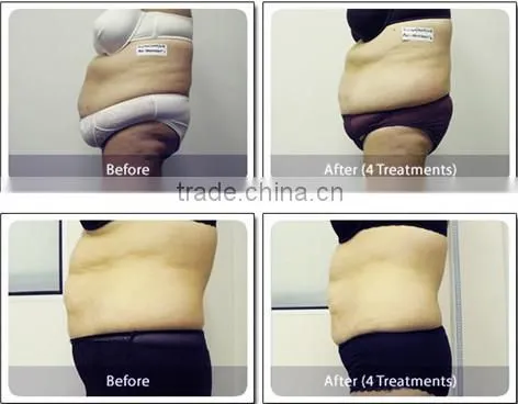 2015 Hot! 2 Freeze Cryotherapy Handles Machine/ Cryo Fat Freezing Machine