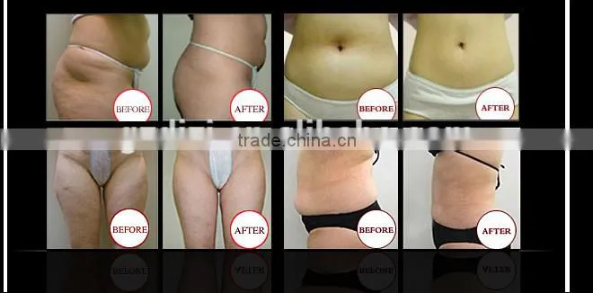 Fast fat reduction Hot popular multifuncion best effective freezing fat reductional machine