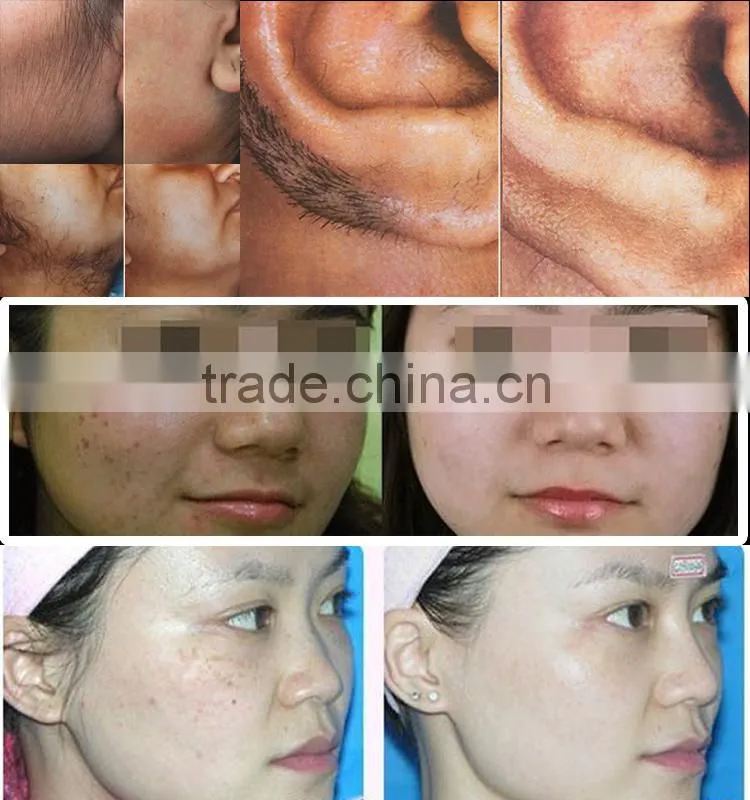 2015 The Best permanent laser hair removal machines home/Salon