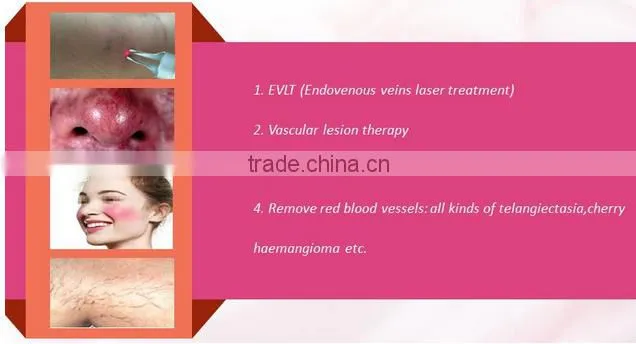 Hotsale Vein Stopper/ Vein Wave Machine/ Spider Vein Removal