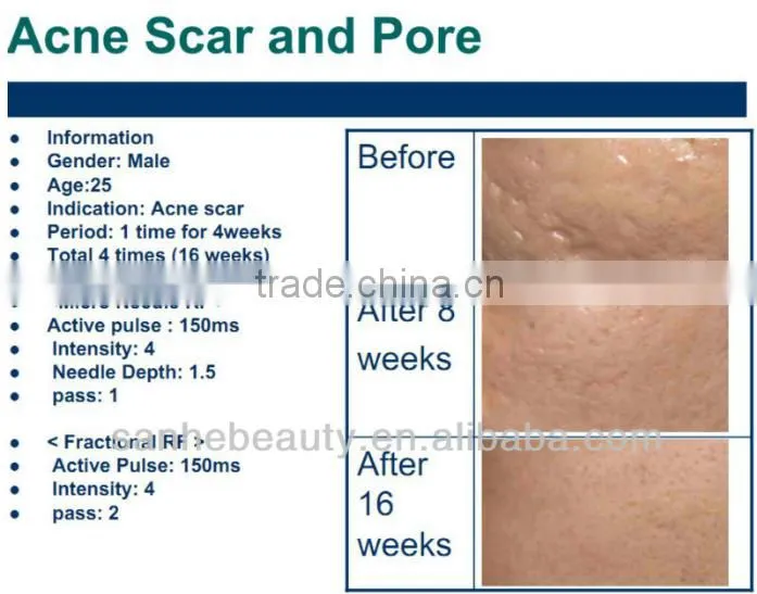 advanced technology face lift fractional microneedle rf machine