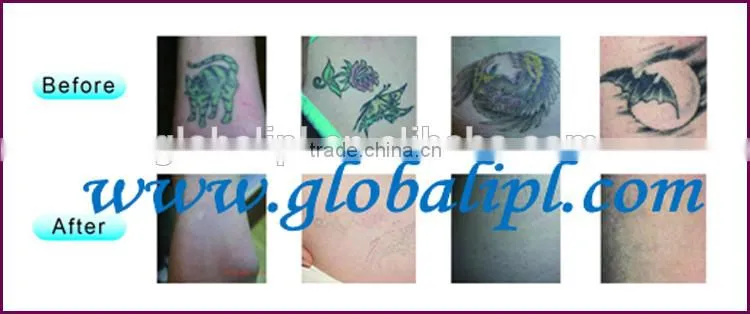 top 1064nm & 532nm to removal all tattoo beauty instrument