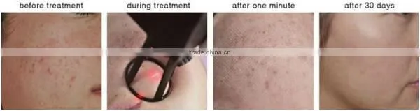2015 fractional co2 laser 30w acne scar removal/fractional co2 laser equipment
