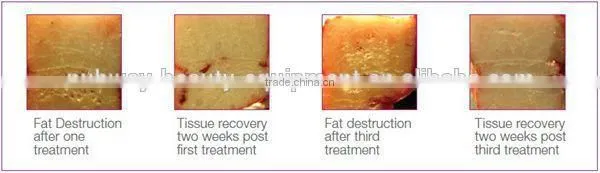 Ultrashape HIFU Body Slimming Machine body sculpture slimming machine