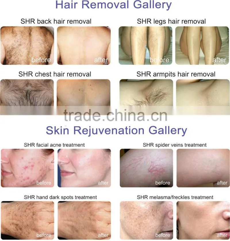 IPL SHR Laser Hair Removal Machine For Sale / ipl laser machine for sale