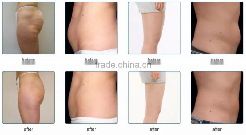 Beijing Sincoheren SUS-D Ultrabox 6 in 1 ultrasonic cavitation rf slimming machine