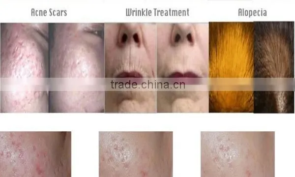 buy 540 titanium microneedle roller skin dermaroller factory hot sale