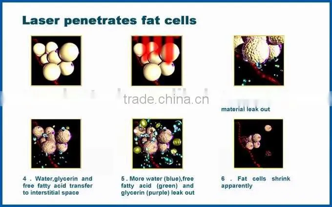 laser fat removal machine