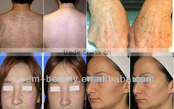 15mm*50mm big spot size Intense pulsed light machinery/IPL Hair removal/ IPL machine with IPL glasses-A003