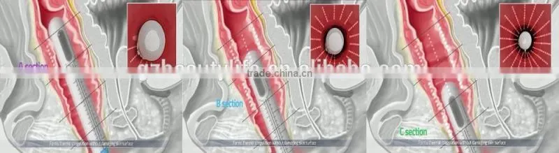 vaginal hifu/hifu 2017