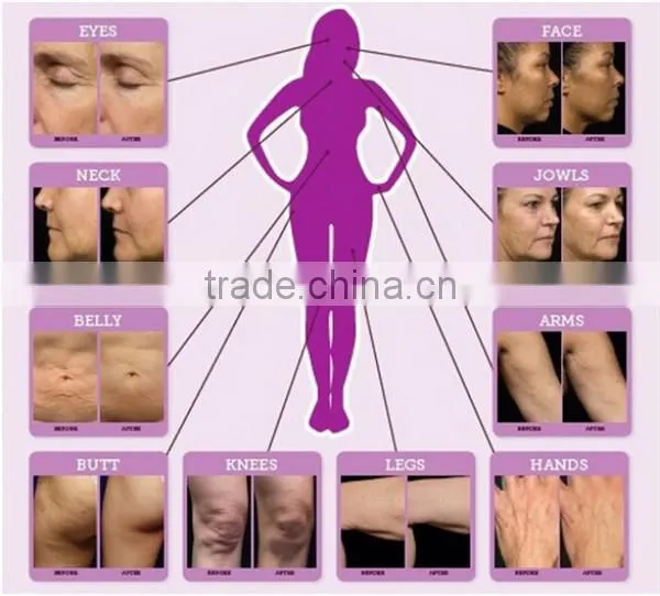 Factory price!!!rf fractional microneedle for Whiten Skin & Restore Skin Elasticity