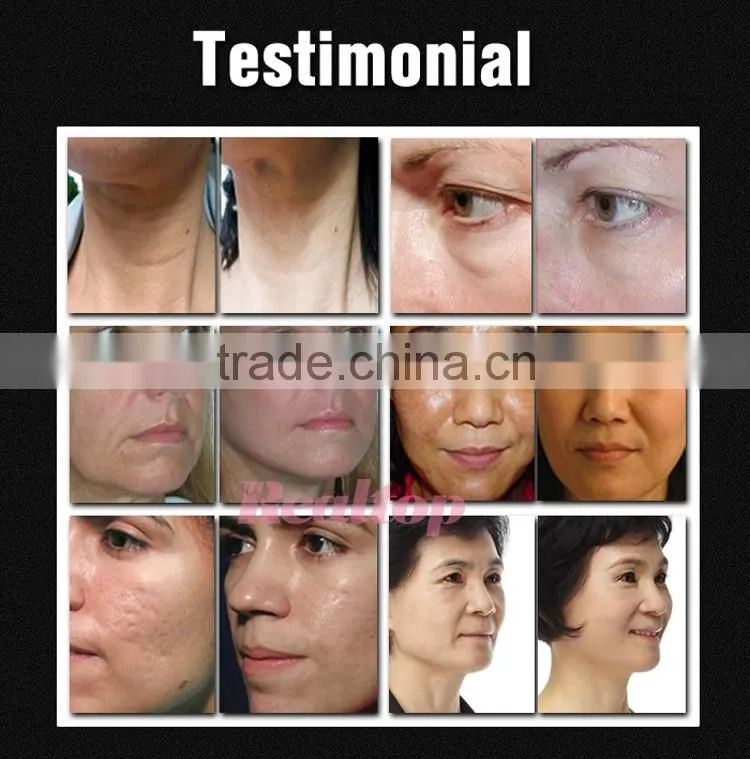 Contemporary Crazy Selling!!5MHZ Fractional RF Face Lift Shrink Pores Treatment RF Thread Lift Face Equipment