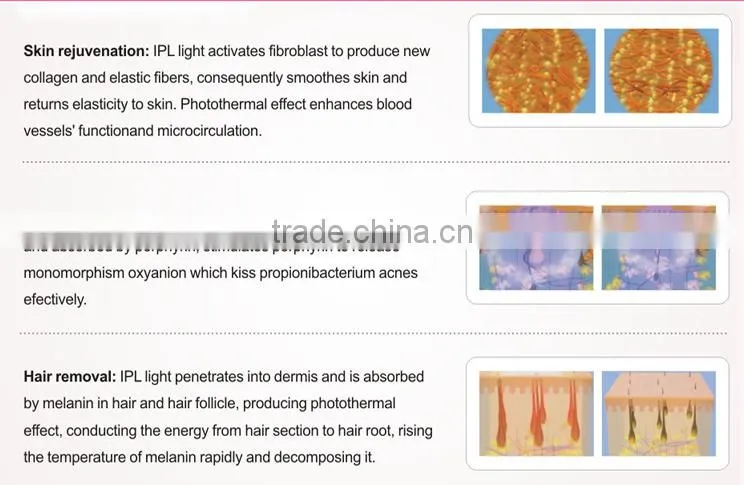 Hair removal machine for women in laser beauty