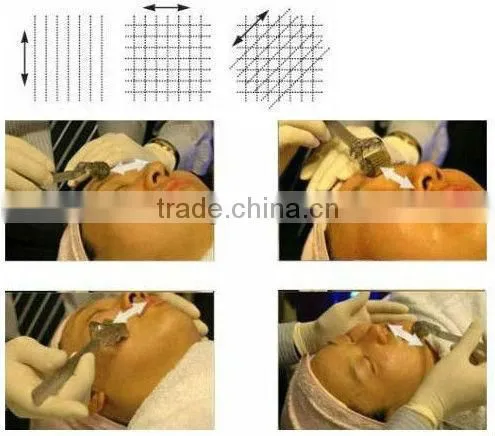 L007 derma roller 1.5 stretch marks, private dermaroller