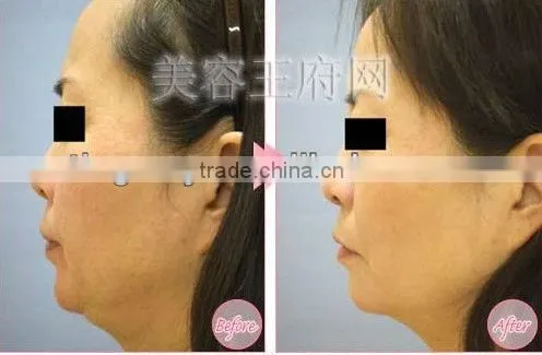 facial exercise machines for home use tm-270