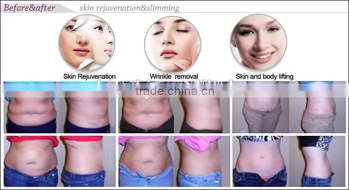 Hot selling CE TUV 650nm laser cavitation vacuum rf fast lost weight