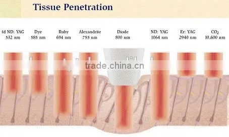 Lingmei 808nm diode laser permanent hair removal laser