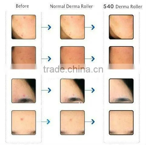 2015 Hot Sale !!! NL-DRS540 skin stamp,dr roller/derma roller,stainless steel derma roller