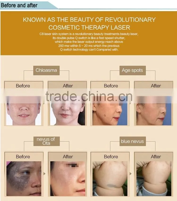 Q-Switch Nd Yag Laser Tattoo Removal System/Q Switched Laser For Tattoo Removal