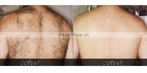 Mini IPL laser hair removal machine home use