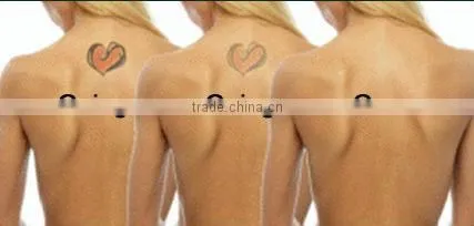 touch screen portable Q-switch permanent beauty tattoo removal laser machine/skin rejuvenation