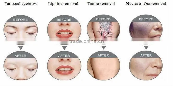 Hot selling ! Nd Yag dermal laser tattoo removal machine