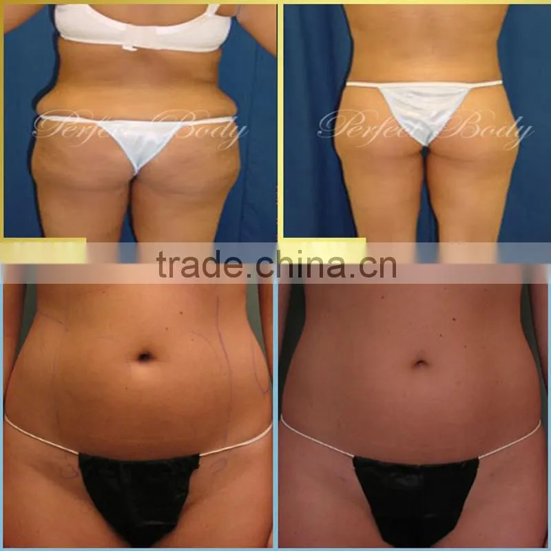 Quick fat freeze machine criolipolise (CE approval )cold lipolysis device