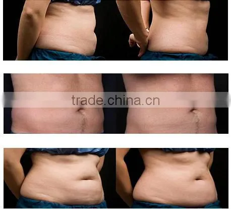 Super Slim Cryotherapy Cryo Lipo Fat Freezing Cryolipolisis Weight Loss Beauty Machine
