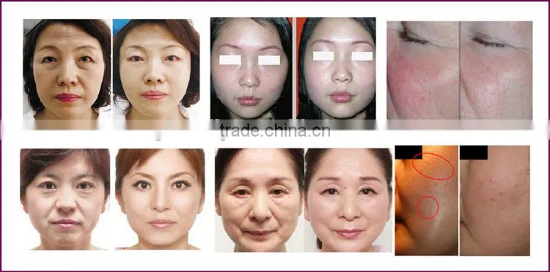 Hot selling machine effective fractional rf machine the face shop cleansing oil
