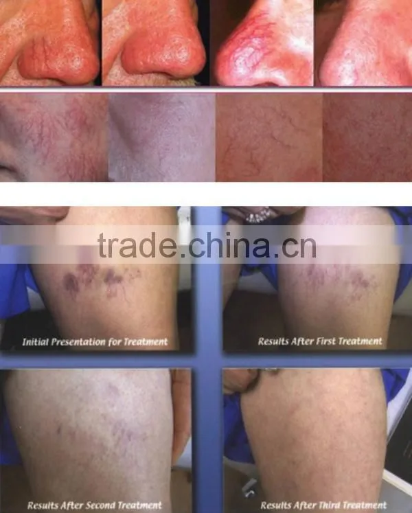 High frequency new viewer rbs spider veins removal vascular laser treatment machine