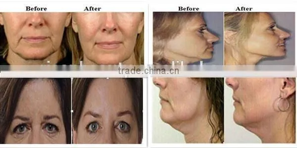Factory Supply Beauty Equipment Thermagic RF Machine