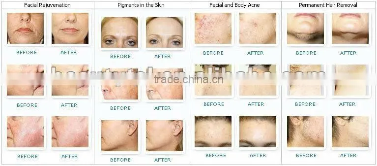 Hottest portable ipl with skin rejuvenation and rf face lifting treatment