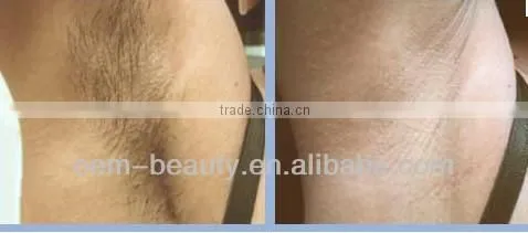 Epilator long pulsed laser yag 1064nm hair removal device for men&women