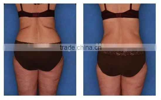 health & beauty weight loss slimming equipment -F017