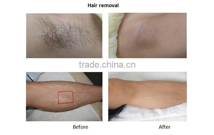 Best selling products portable IPL beauty machine for home use/ipl hair removal