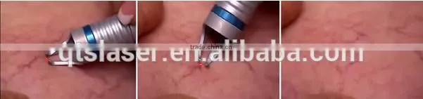 2016 new 980nm diode laser for vascular removal blood vessels removal/anti-redness remover/skin care