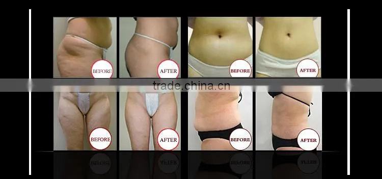 Big discount!!! Best seller freeze machine cryo freezing fat removal body slimming machine for salon use