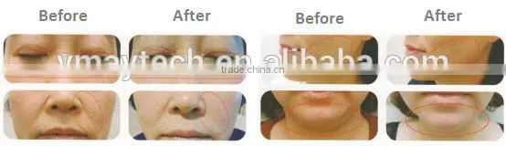 Best hifu face lifting machine hifu ultrasound hifu for salon use clinic use FU-5S