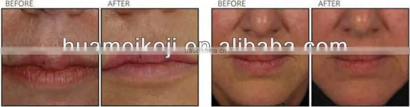 popular co2 fractional laser system