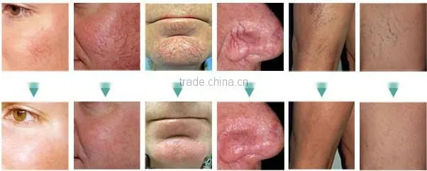 Beauty Equipment Electrolysis Blend Machine Telangiectasia for Spider Vein Removal