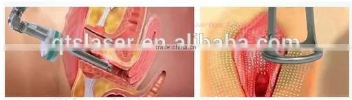 UltraPulse co2 laser fractional laser for scar removal