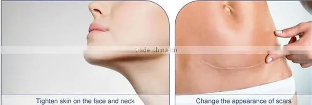 powerful laser 3 in 1 for dermatology and gynaecology use