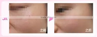 Laser skin machine hair removal device for permanent hair removal skin rejuvenation and acne clearance with 3 lamps