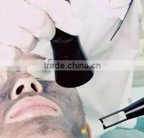 Multifunction Ng:yag lase tattoo removal device